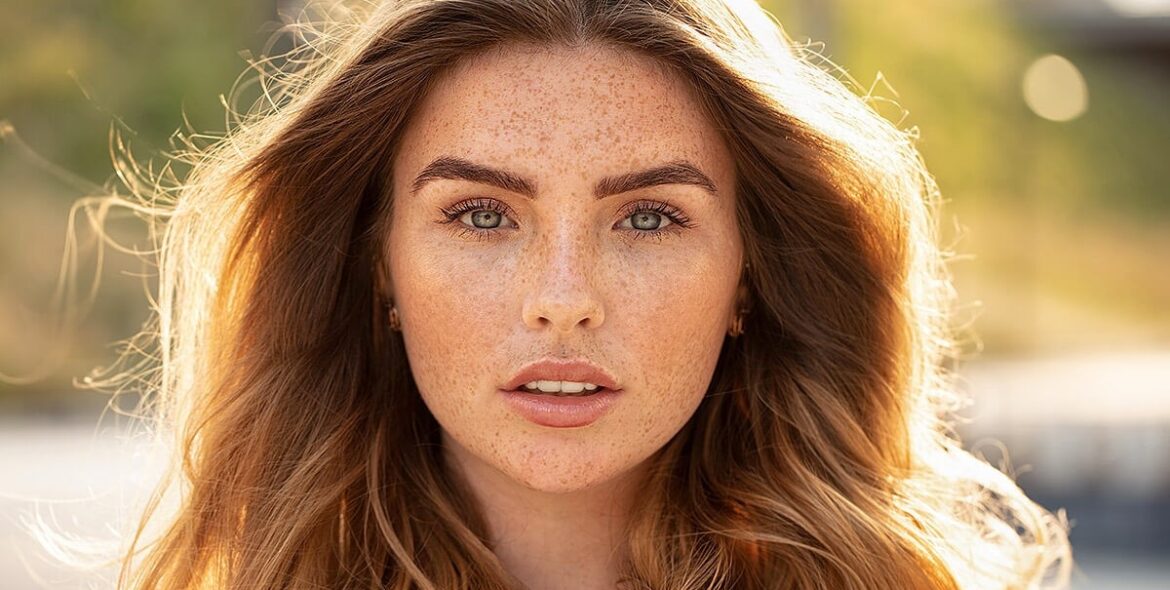 How Can I Remove Freckles at Home?
